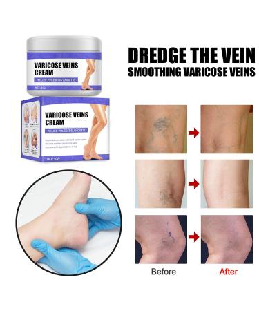 Vein Care Fading Cream 30g - Spider & Varicose Veins Treatment | Improve Leg Appearance & Circulation - 3 Pack - Buy Online on GoSupps.com