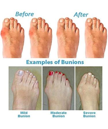 Womens Wedge Platform Sandals - Soft Big Toe Foot Bunion Correction Beach Sandals | Orthopedic Open Toe Travel Shoes in Black (Size 7.5 - Buy Online on GoSupps.com