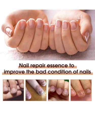 Health Routine Nail Care Pen for Nail Fungus Treatment - Effective Solution for Healthy Nails (1PC) - Buy Online on GoSupps.com