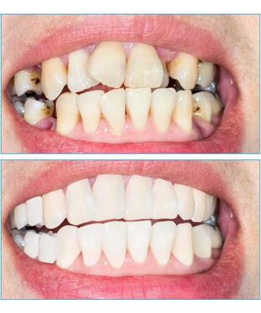 Jiazhou Hub Temporary Prostheses: 2 Pairs Cosmetic Veneers & Snap-On Dentures for a Natural Smile - Buy Online on GoSupps.com