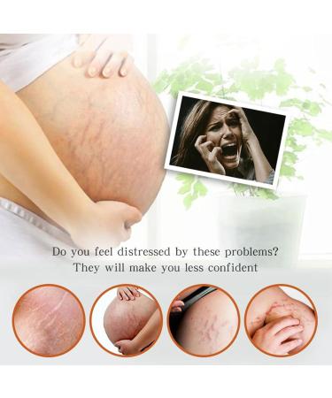 Stretch Mark Cream - Body Skin Care - Body Oil for Women - Firming & Lifting Body Oil - Stretch Marks Removal Skin Care Oil - Improves the Appearance of Stretch Marks Restore Skin Elasticity Body Oil - Buy Online on GoSupps.com