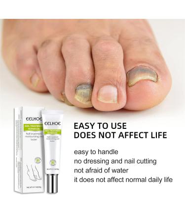 2PCS Nail Repair Essence Cream - Restores Discolored/Damaged Nails - Toe Beauty Cream for Toenail Care - Buy Online on GoSupps.com