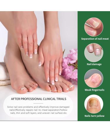 Extra Strength Toenail Fungus Treatment - 30ml | Effective Nail Fungus Solution for Thick Broken & Discolored Nails - Fast Shipping Internationally - Buy Online on GoSupps.com