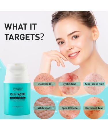 Acne Gel for Cystic & Hormonal Treatment | Max Strength Salicylic & Azelaic Acid | Blemish Remover for Face Body & Back | Pimple Cream for Teens & Adults | 1.7 oz (50 ml - Buy Online on GoSupps.com