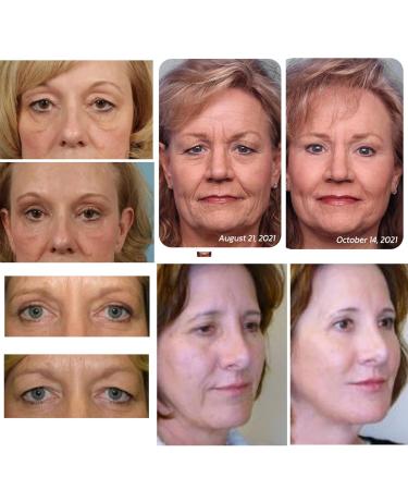 Openeyes Awaken Peptide Lifting Eye Gel for Women and Men - Dark Circles & Puffiness - 2pcs - Buy Online on GoSupps.com
