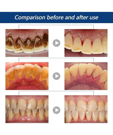 Calculusfree Dissolving Dental Spray - Powerful Dental Calculus Remover & Mouth Refreshing Spray (3 PCs) | Intensive Stain Removal for Clean Teeth - Buy Online on GoSupps.com