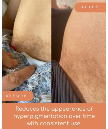 Down Low Inner Thigh Serum | Brighten Dark Spots in Bikini Area & Inner Thighs | Best International Shipping - Buy Online on GoSupps.com