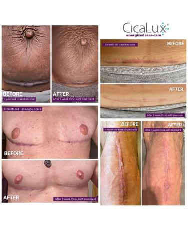 CicaLux Silicone Scar Tape - Triple Action Treatment for Surgical Scars - 60 Day Supply - Buy Online on GoSupps.com