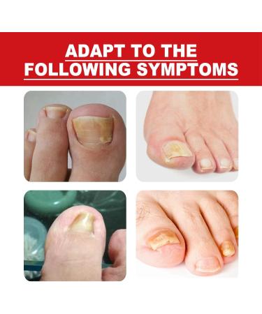 Ingrown Toenail Treatment Oil for Thick, Damaged Nails - Toenailplus Anti Paronychia Relief - Buy Online on GoSupps.com