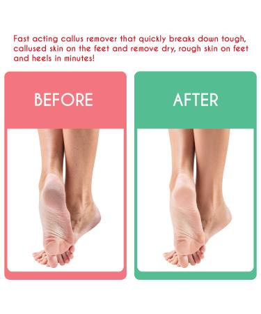 Buy Tachibelle Callus Remover ULTRA Scent - Professional Dead Skin Eliminator for Feet (8 oz) | Fast International Shipping - Buy Online on GoSupps.com