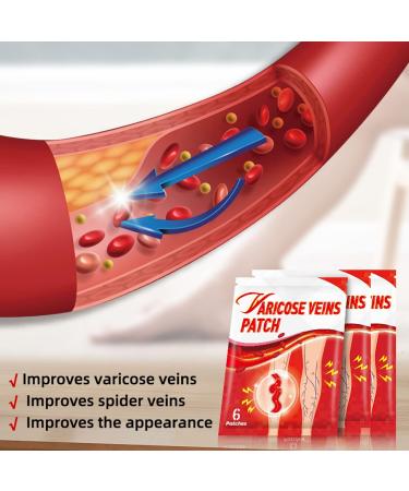 Spider Vein Plaster 30ct | Varicose Vein & Phlebitis Care | Leg Vein Removal Treatment - Buy Online on GoSupps.com