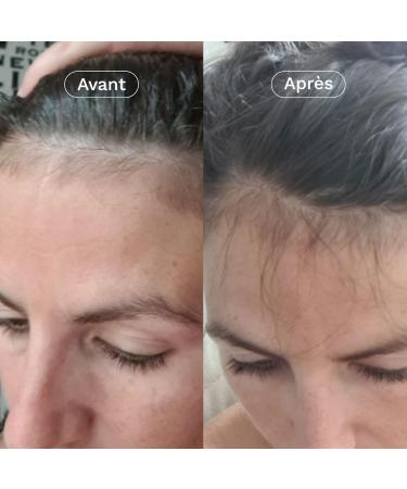 OMUM - In&Out Hair Duo Gift Box: 1 Organic Boost Lotion + 1 Anti-Hair Loss Food Supplement - Stimulates hair growth strengthens from 45 days - Natural France Vegan - Buy Online on GoSupps.com