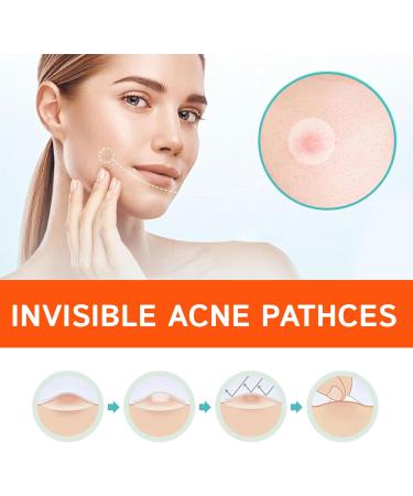 Fast-Acting Hydrocolloid Acne Patches | 72 Invisible Stickers for All Acne Types | Covers Pimples Hides Spots & Removes Oil - Shop Now - Buy Online on GoSupps.com