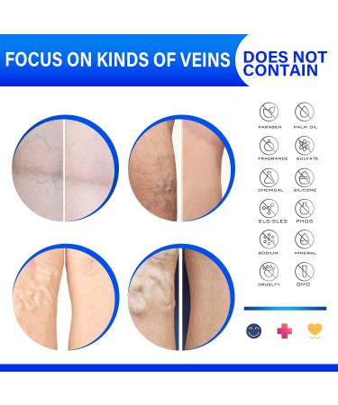 Varicose Veins Cream - Effective Treatment for Legs | Strengthen Capillaries, Improve Circulation | Relief Phlebitis Angiitis Inflammation | 1.7 Fl Oz - Buy Online on GoSupps.com
