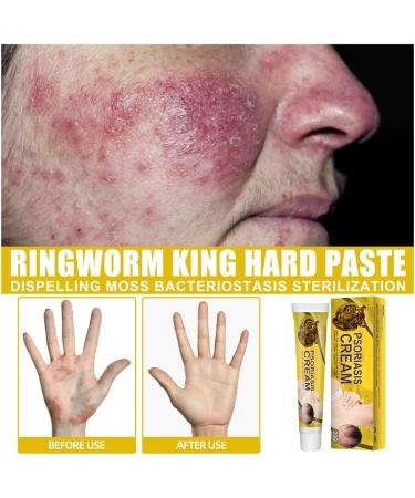 VEJIA Eczema Psoriasis Treatment Cream 20g - Dermatitis Pruritus Relief Ointment for Adults (3pcs) - Buy Online on GoSupps.com