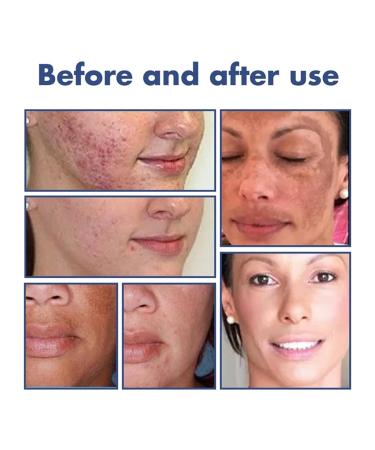 BIERELAOZI Skinenjoy Cleansing Lotion for Acne & Spots - Acanthosis Nigricans Therapy Cream | Dark Spot Remover for Face & Body (1 PC) - Buy Online on GoSupps.com