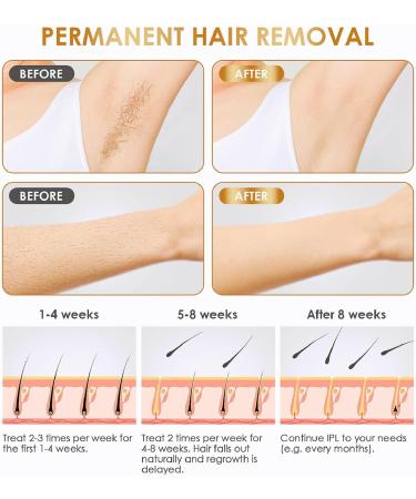 Home Use Hair Removal Device for Women & Men - 999 999 Flashes | At-Home Beauty Solution - Buy Online on GoSupps.com