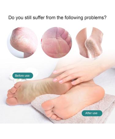 Buerfu Heel Scrubber Clear Foot File - Clear in-Shower Foot Scrubber Callus Remover Pedicure Foot File for Smoothing Feet Dead Skin Big Magatama - Buy Online on GoSupps.com
