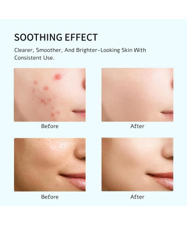 10% Azelaic Acid Serum Facial Serum for Sensitive skin Hyaluronic Acid Niacinamide Reduces Acne Marks Redness Relief & Hydration(30ml/ 1.01 fl oz.) - Buy Online on GoSupps.com