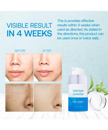 Dark Spot Remover for Face & Body - Hyperpigmentation Treatment - Age Spot Corrector - Brightening Serum - 1 FL OZ - All Skin Types - Buy Online on GoSupps.com
