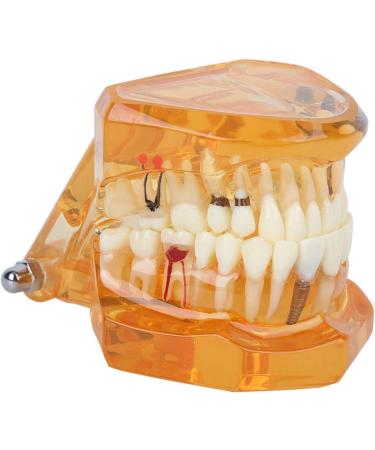 Dpofirs Orange Dental Model - Removable Teaching Tool for Dental Programs Adult Tooth Demonstration & Dental Implants - Buy Online on GoSupps.com