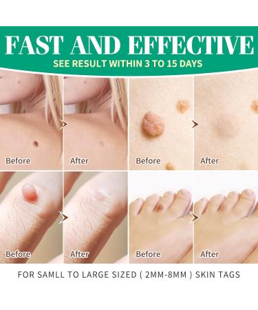 Buy La. Personal Warts Review Kit - Skin Tag Remover with 40 Repair Patches Safe & Painless for All Body Parts (2mm to 8mm) - Buy Online on GoSupps.com