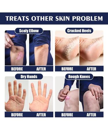 Moisturizing Foot Cream Beeswax Cracked Heel Repair Cream Foot Moisturiser Cream with Shea Butter Feet Hard Skin Remover Foot Callus Remover Relieving Chapped Heels and Rough Feet for Hand & Foot - Buy Online on GoSupps.com