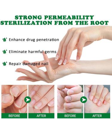 Traitement des champignons ongles de 7 jours Ginger Nail Support Nails Care 1 fl.oz S rum de r paration des ongles polyvalents pour les ongles minces cassants peelings et fissur s (2pcs) - Buy Online on GoSupps.com