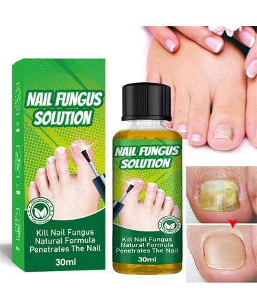 ERFD Toenail fungus care Fungal Nail Cure for Toenails Extra Strong 30ml Anti Fungal Toe Nails Treatment