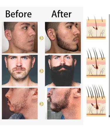 Beard Growth Kit: Oil, Serum, 0.5MM Derma Roller & Grooming Tools for Rapid Thickening - 2PCS - Buy Online on GoSupps.com