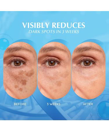 EnaSkin Dark Spot Remover Face & Body Serum: Age Spot Sun Spot Freckles Melasma Brown Spot - Advanced Formula with Niacinamide for Women and Men (4.0 Fl Oz) 4 Fl Oz (Pack of 1) - Buy Online on GoSupps.com