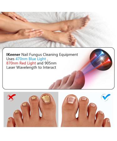 Ikeen Nail Fungus Treatment Device - Effective Onychomycosis Relief with Red & Blue Light Painless & Fast Fuzspilz Solution for Healthy Nails - Buy Online on GoSupps.com