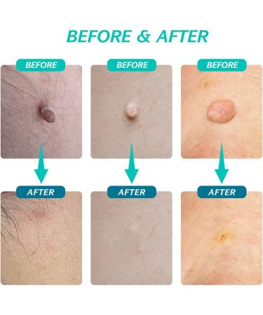 2 in 1 Skin Tag Remover Pen Kit - Painless Micro Skin Tags & Moles Removal for All Body Parts - Buy Online on GoSupps.com