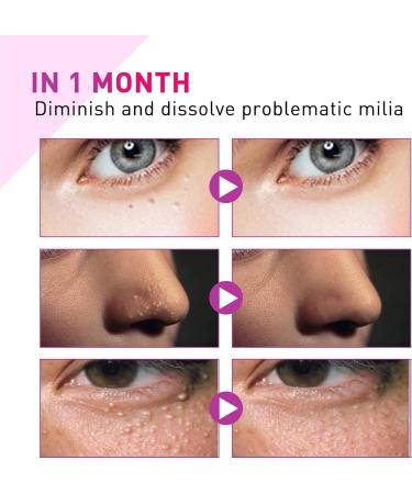 GHEART Fading Dark Circles Essence Remover Milia Spot Treatment Eye Milia Remover Skin Dark Spot Remover for Face Dark Spots Removal Treatment Spot Treatment Milia Remover Skin Dark Spot Remover 15g - Buy Online on GoSupps.com