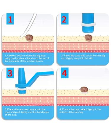 30 Pieces Skin Day Distant Rubber Bands | Fast & Safe Wart Removal | Non-Toxic Skin Care Tools - Buy Online on GoSupps.com