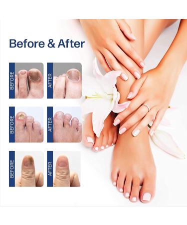 Nail Fungal Treatment Spray - Advanced Toenail & Nail Strengthener Repair - 10ml - Buy Online on GoSupps.com