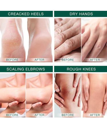 Cracked Feet Cream - Moisturizing Hand Cream 42% With 3.5 oz Cream for Men That Remove Dead Skin from Foot Calluses - Buy Online on GoSupps.com