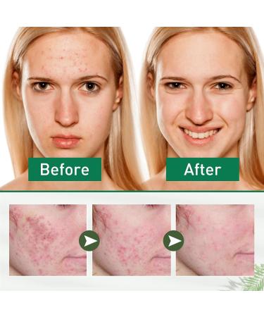 Tea Tree Ance Treatment Serum Tea Tree Oil For Skin Tea Tree Essential Oils Anti-Pimples and Acne Moisturizer and Brighten Skin.Tea Tree Oil for Diffuser Humidifier DIY Home Office 17ml - Buy Online on GoSupps.com