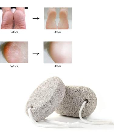 PHOGARY Natural Pumice Stone 2 PCS Set - Hard Skin Callus Remover for Feet & Hands - Foot File Exfoliation Tool for Dead Skin Removal - Buy Online on GoSupps.com