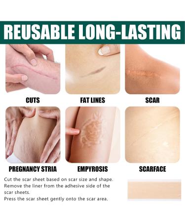Silicone Scar Sheets Roll - 1.6x60inch | Soft Gel Tape for Scar Removal - Medical Grade, Reusable | C Section, Keloid, Surgery, Burn, Acne - Buy Online on GoSupps.com