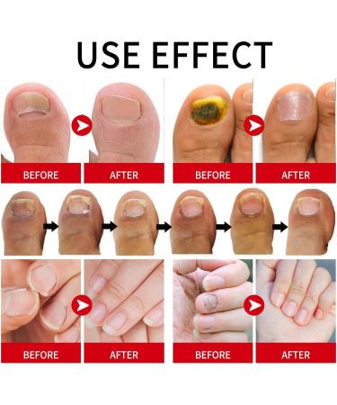 Cuticle and Nail Oil Nail Growth Restorative Oil Portable Cuticle Conditioner Nail Strengthener Mild Cuticle Oil for Adults Children Hailerio - Buy Online on GoSupps.com