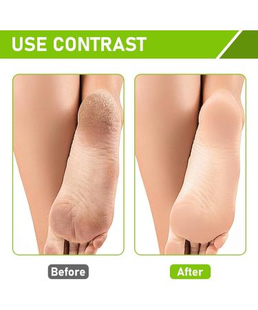 Horktrust Peeling mask for dry and cracked feet with lactic acid and olive oil removes calluses and dead skin in 27 days treatment for men and women - Buy Online on GoSupps.com