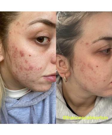 Buy Carbon Theory Overnight Detox Facial Serum | Charcoal Tea Tree Oil & Vitamin E | 30ml - International Shipping Available - Buy Online on GoSupps.com