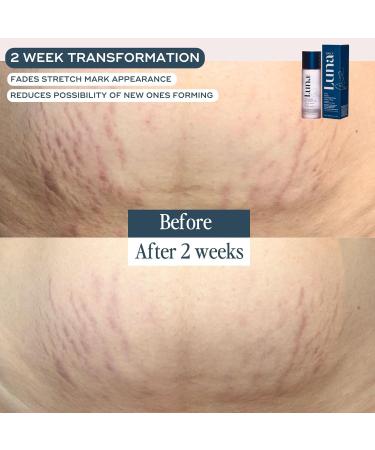 The Skin Support Oil 100ml | Vegan Hydrating Body Care for Scars & Stretch Marks | Natural Fragrance-Free Vitamin C & Soothing Calendula | Pregnancy Safe Even Tone - Buy Online on GoSupps.com