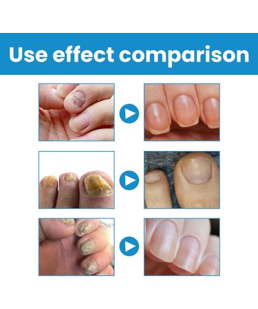 Natural Nail Strengthener Foot Nail Nourishing Spray 100ml Nonsticky Strengthening Spray for Damaged Cracked Brittle Nails for Daily Hand and Foot Care - Buy Online on GoSupps.com