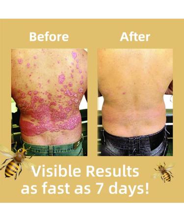 XRCZYM Bee Psoriasis Treatment Cream - Soothing & Moisturizing Professional Formula from New Zealand (3pcs) - Buy Online on GoSupps.com