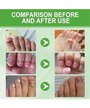 Keratin 3 Day Growth Nail Treatment & Strengthener Nail Strengthener for Damaged Nails Extra Strong Nail Growth Treatment Nail Repair Treatment Nail Strengthener and Growth Polish Nail Growth Serum - Buy Online on GoSupps.com