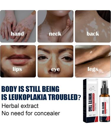 KOAHDE Psoriasis Treatment Spray Vitiligo Relief Spray Psoriasis Control Face and Body Cream Soothing and Moisturizing Coal Tar Psoriasis Cream Spray Psoriasis Control White Spot Spray 30ml 1PC - Buy Online on GoSupps.com