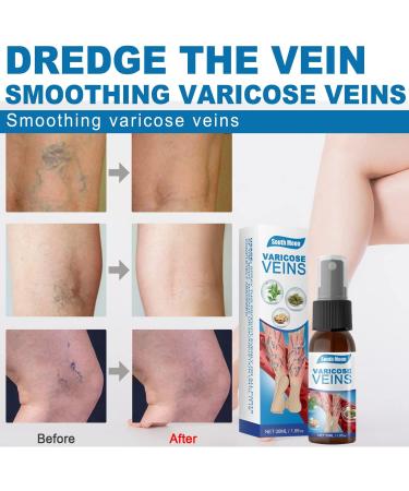 2pcs Veinhealing Varicose Veins Treatment Spray Veinhealing Varicose Veins Spray Vein Healing Varicose Veins Treatment Spray for Legs Varicose Veins Miracle Spray (30ml) - Buy Online on GoSupps.com