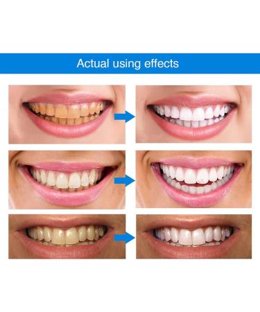 Dentiz Gum Therapy Gel & Tooth Elevator Essence Pin | Tooth Whitening Gel Stain Remover - 2-Pack (4 ml) for Optimal Oral Health - Buy Online on GoSupps.com